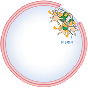 clot forms and stabilizes with normal clotting